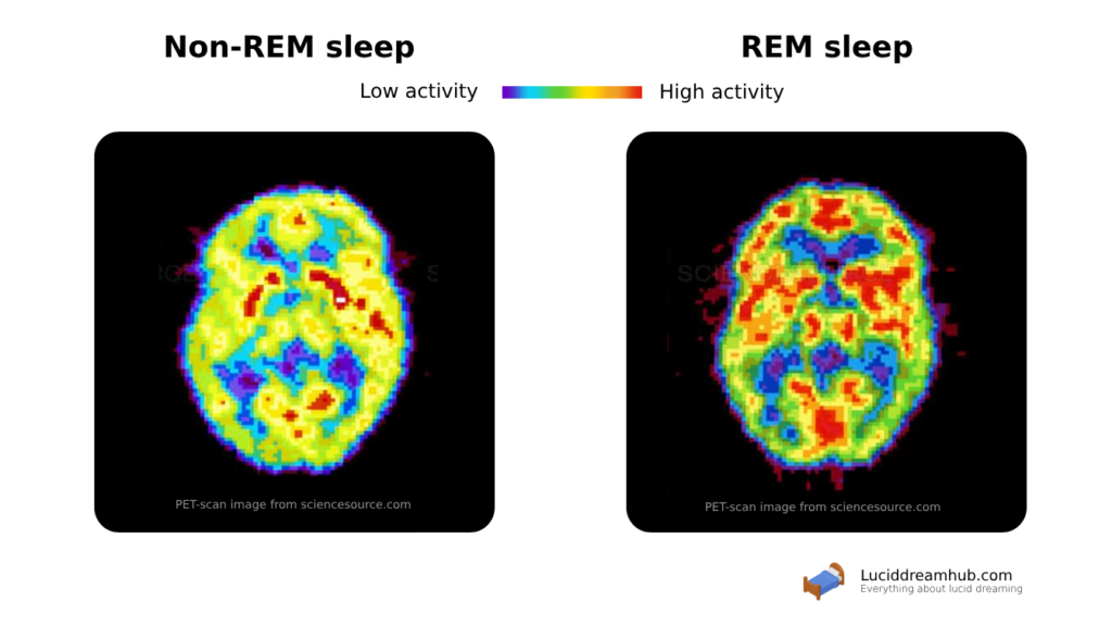 A side by side view of PET brain scans during REM sleep and Non-REM sleep. Showing heightened brain activity while in REM.